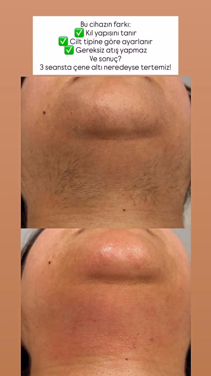 Lazer Epilasyon Bursa (2)