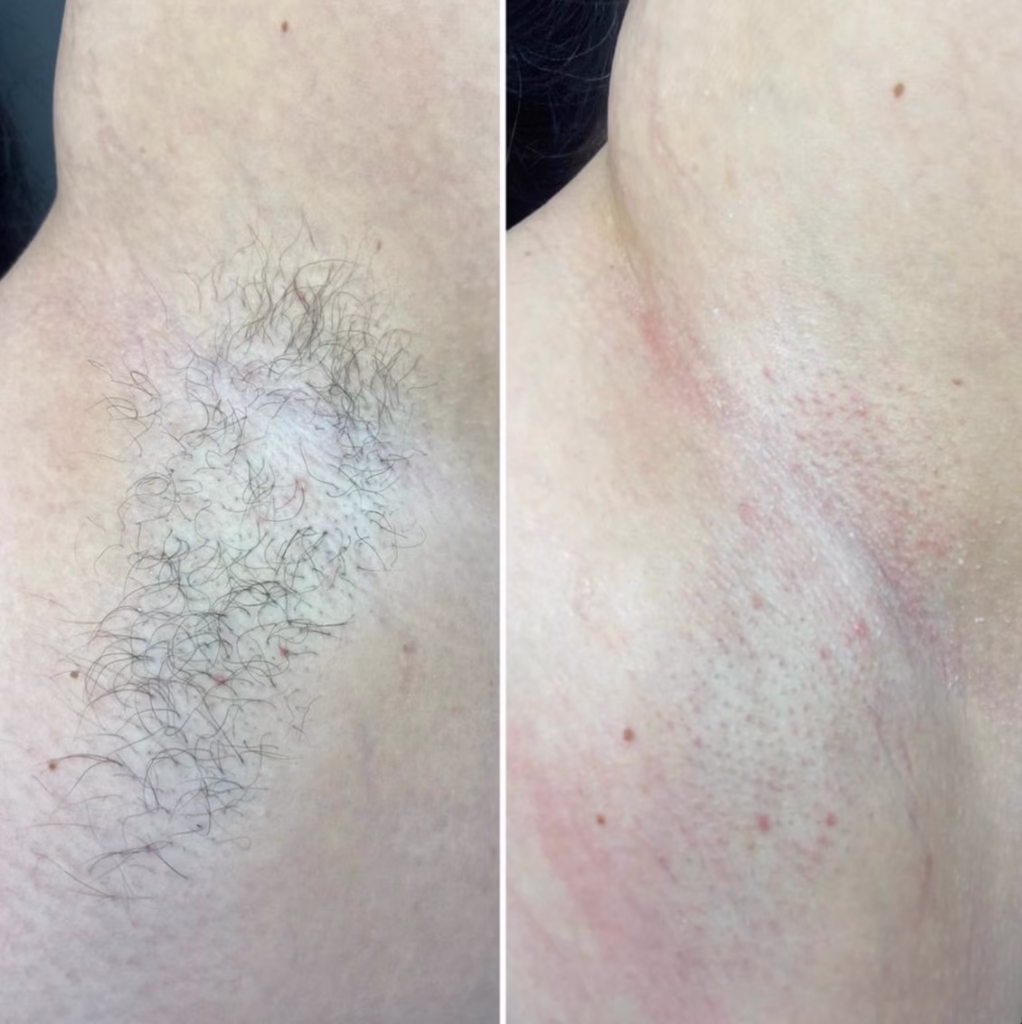 Lazer Epilasyon Bursa (3)