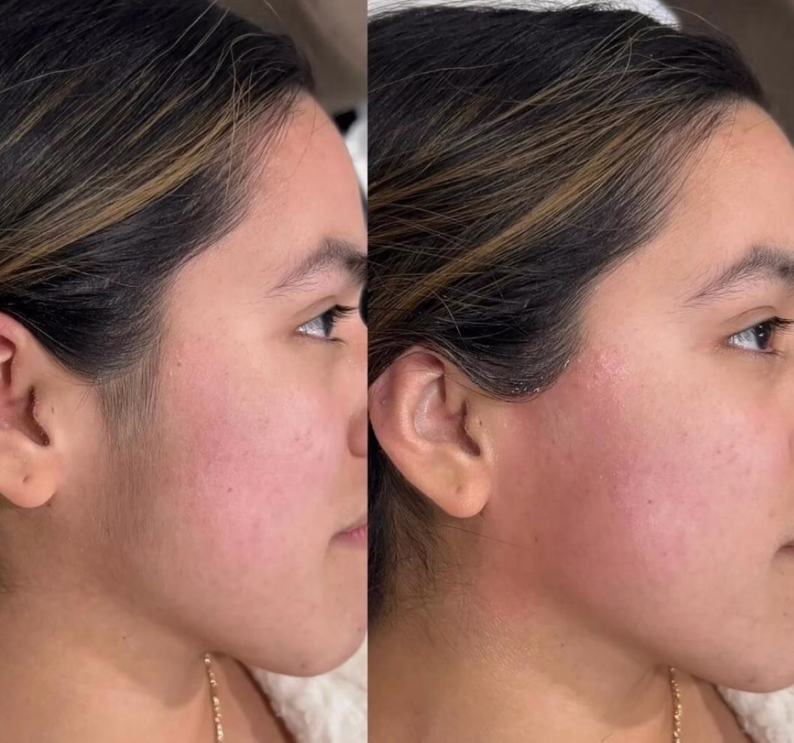 Lazer Epilasyon Bursa (5)